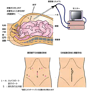 腹腔鏡手術