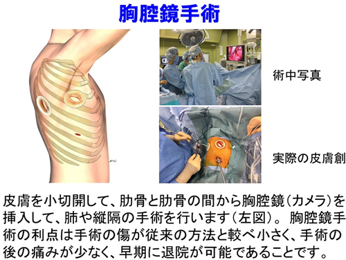 腹腔鏡手術