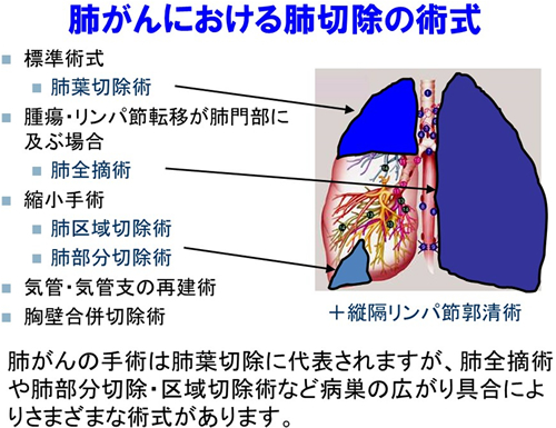 肺がんにおける肺切除の術式