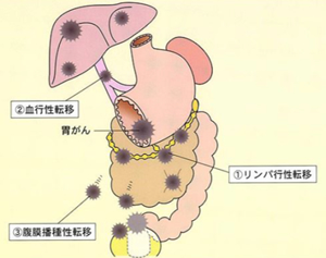 がんの転移