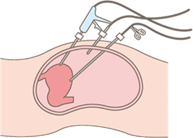 腹腔鏡下手術の実際