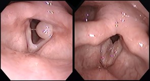 声帯ポリープ/ポリープ様声帯