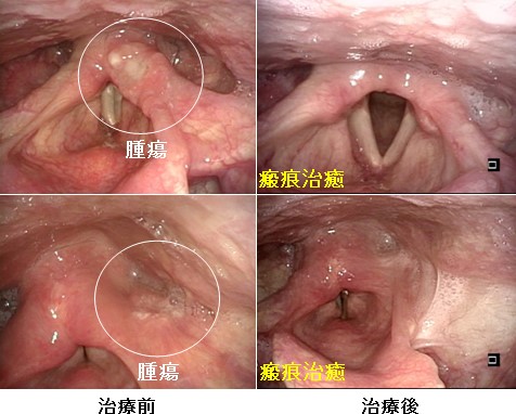 3. 内視鏡下経口的腫瘍切除