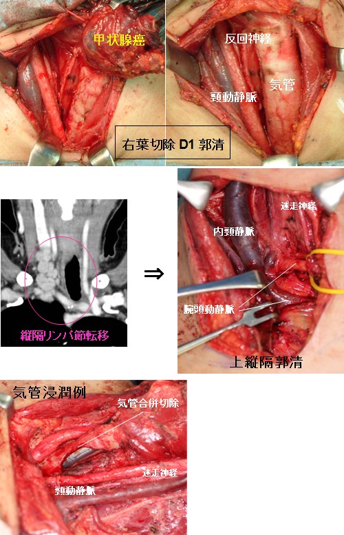 5. 甲状腺腫瘍