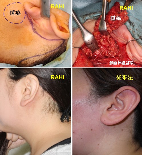 6. 耳下腺腫瘍