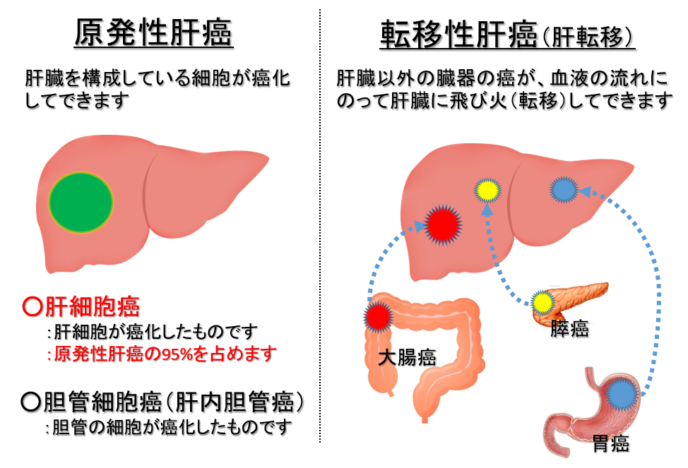 原発性肝がんと転移性肝がん