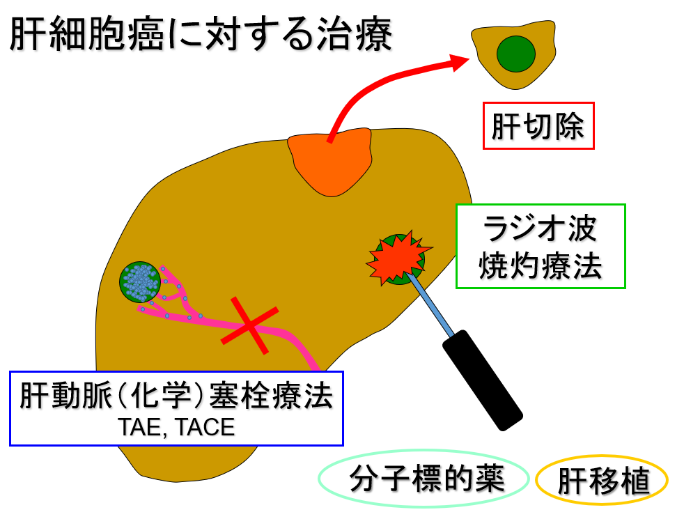 肝細胞がんに対する治療