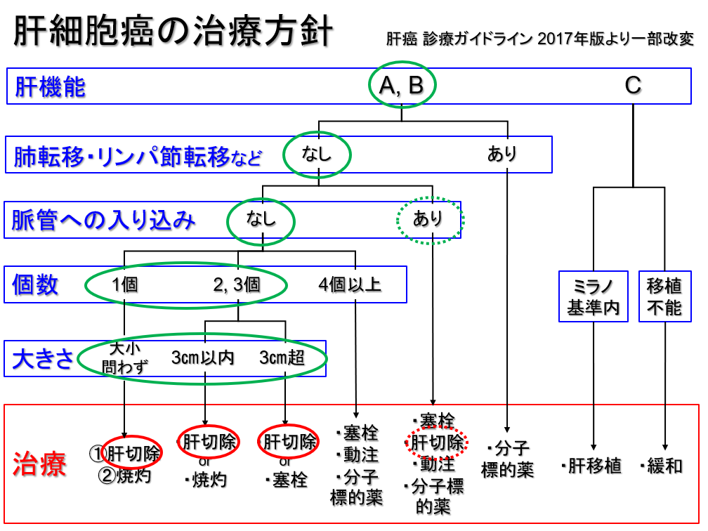 肝細胞がんの治療方針