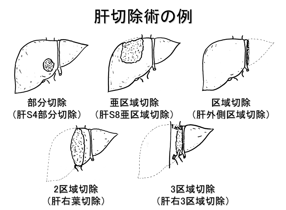 肝切除について