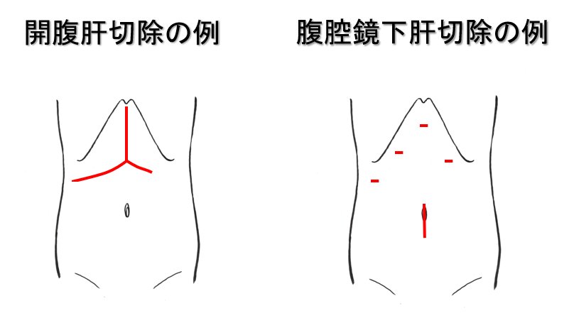 肝切除について