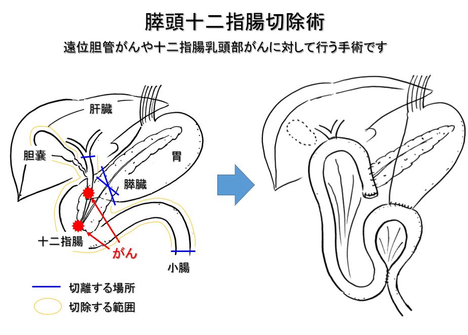 胆道がんについて