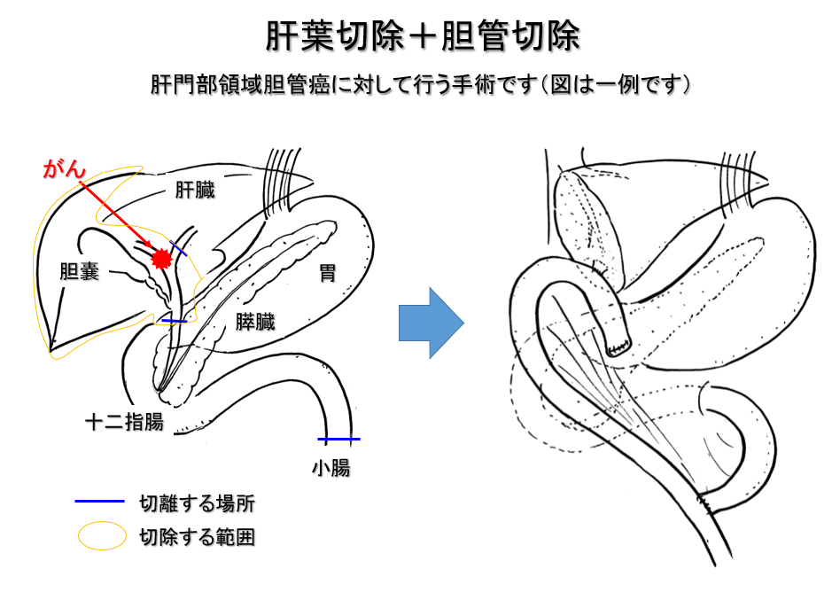 胆道がんについて