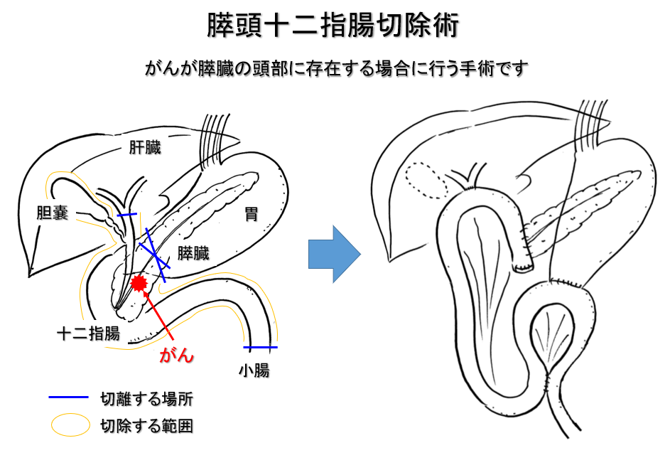 膵がんに対する外科的治療