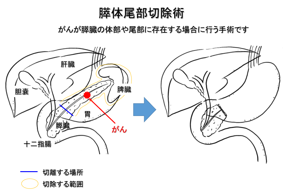 膵がんに対する外科的治療