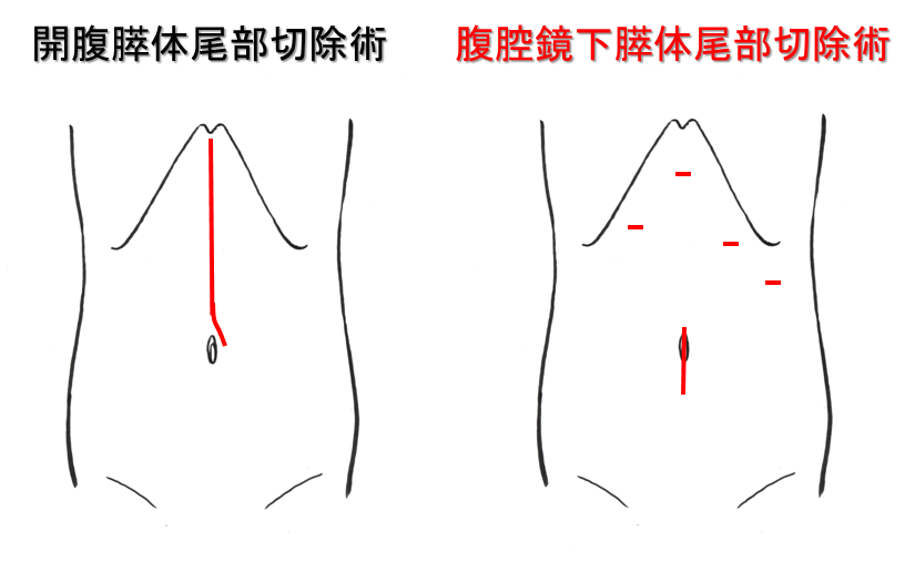 膵がんに対する外科的治療