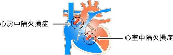 代表的な先天性心疾患