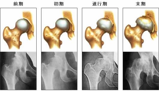 変形性股関節症