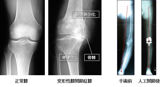 変形性膝関節