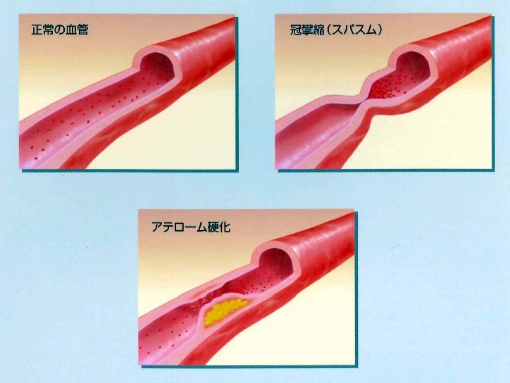 正常冠動脈と狭心症の病態