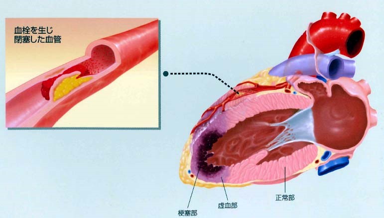 心筋梗塞