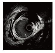 血管内超音波(IVUS)