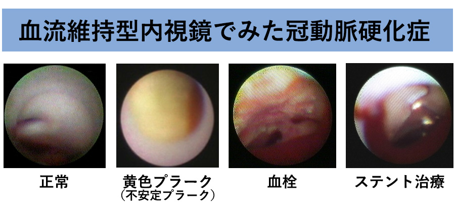 血管内視鏡装置