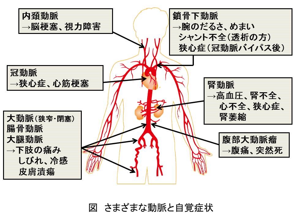 さまざまな動脈と自覚症状