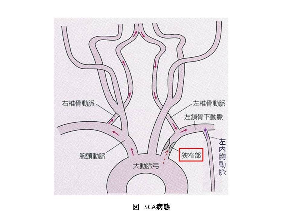 鎖骨下動脈狭窄症