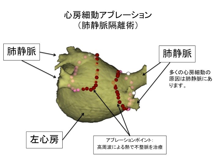 心房細動に対するアブレーション治療