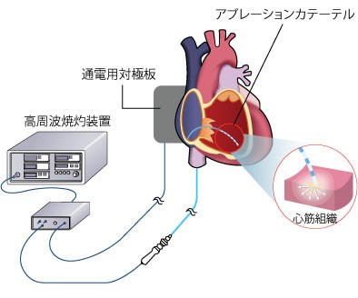 心房細動に対するアブレーション治療