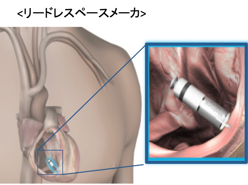 Leadless pacemaker