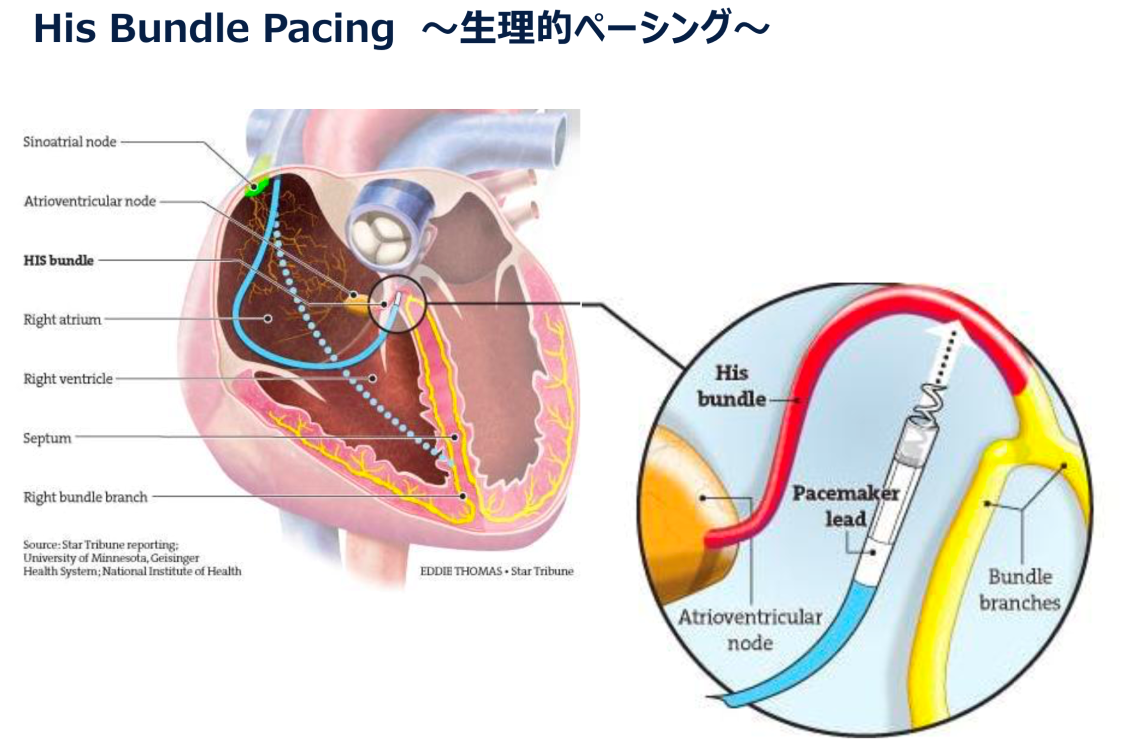 His bundle pacing