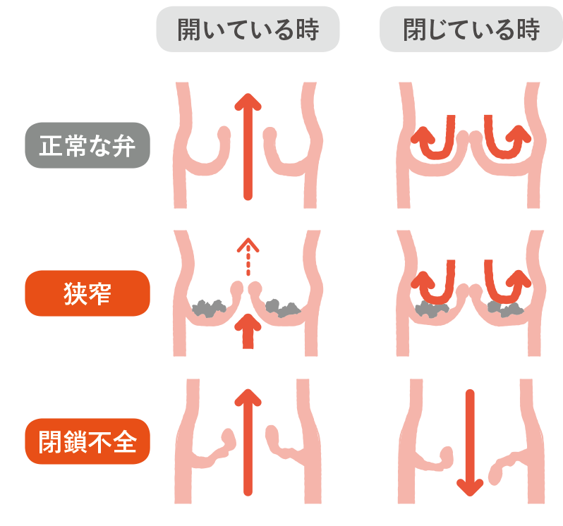 閉鎖不全症症(逆流症)