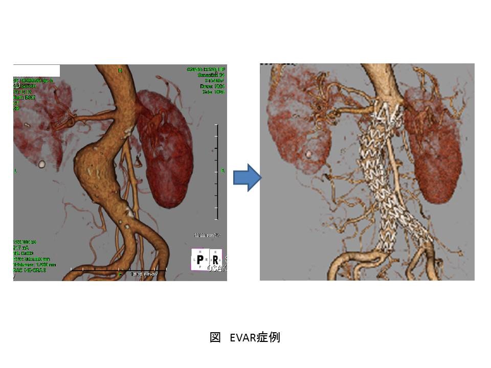 EVAR症例