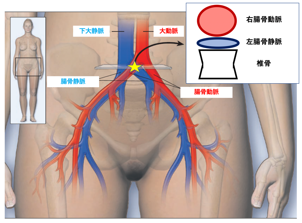 腸骨静脈圧迫症候群