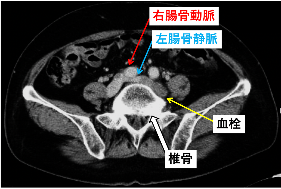 腸骨静脈圧迫症候群の造影CT