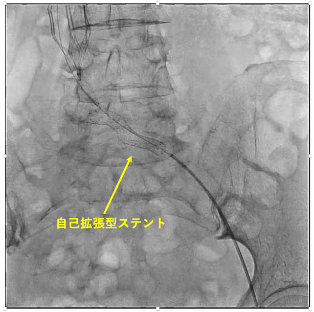 腸骨静脈圧迫症候群へのステント治療