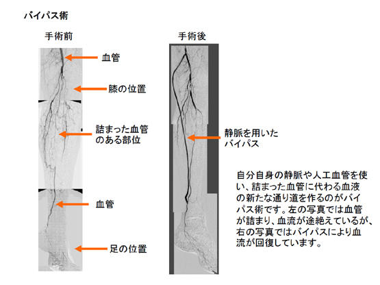 下肢閉塞性動脈硬化症