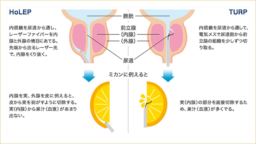 HoLEPとTURPの違い