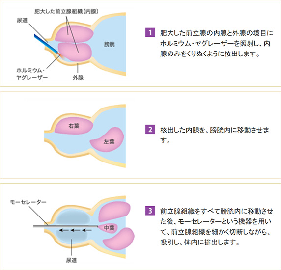 HoLEPの方法