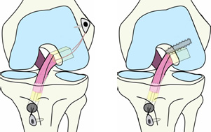 前十字靭帯再建の方法（骨付き膝蓋腱）