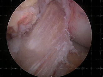 再建した靭帯（関節鏡）
