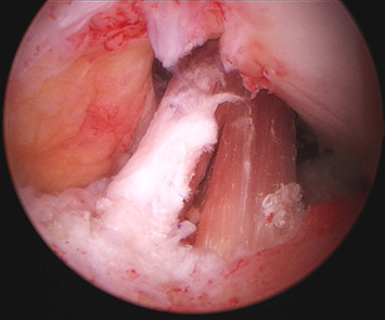 再建した靭帯（関節鏡）