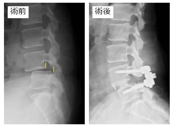 腰椎後方椎体間固定術