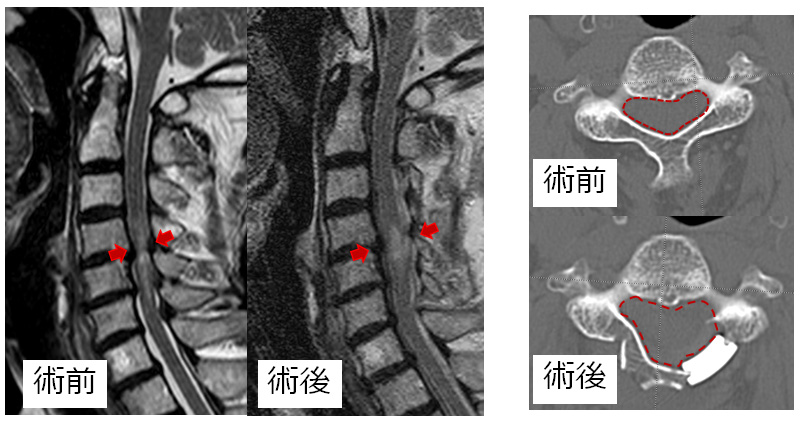 頚椎椎弓形成術