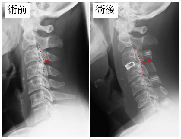 前方除圧+椎弓形成術固定術