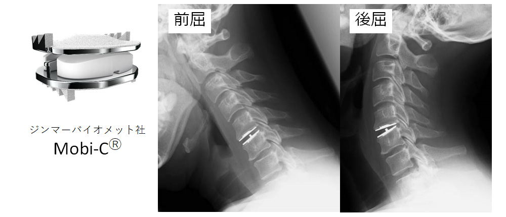 頚椎人工椎間板置換術