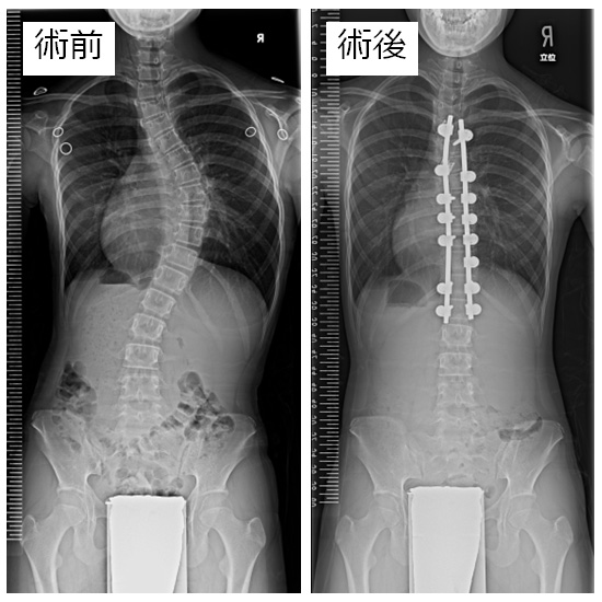 特発性側弯症に対する後方矯正固定術