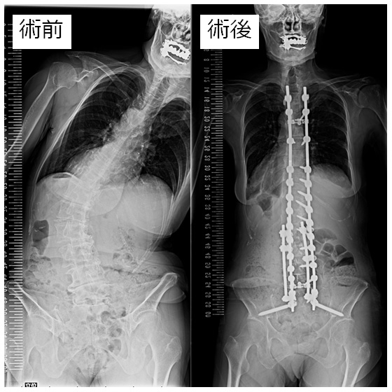 成人脊柱変形に対する脊椎矯正固定術