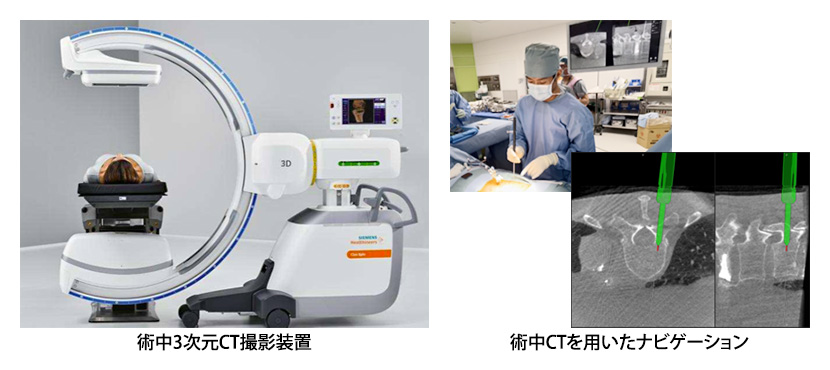 左：術中3次元CT撮影装置、右：術中CTを用いたナビゲーション